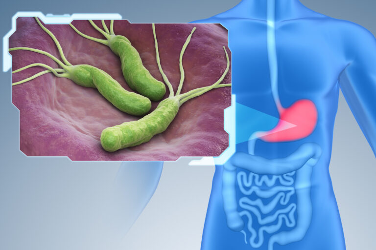 Chile presenta importantes niveles de contagio de bacteria asociada al cáncer gástrico