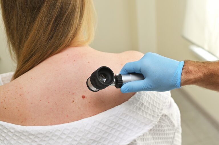 Precisan diagnósticos de cáncer de piel de tipo melanoma con Inteligencia Artificial