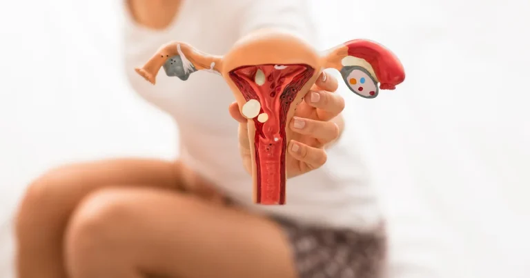 Endometriosis: Cuando el dolor menstrual esconde algo más 