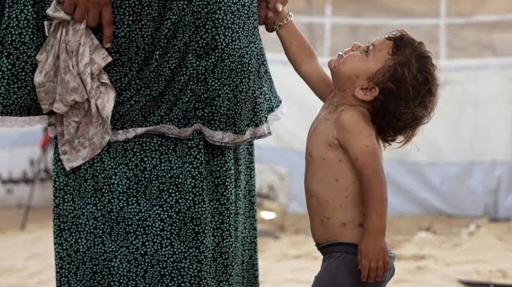 Embajada de Palestina en Chile alerta sobre brote de varicela y agravamiento de la crisis humanitaria en Gaza