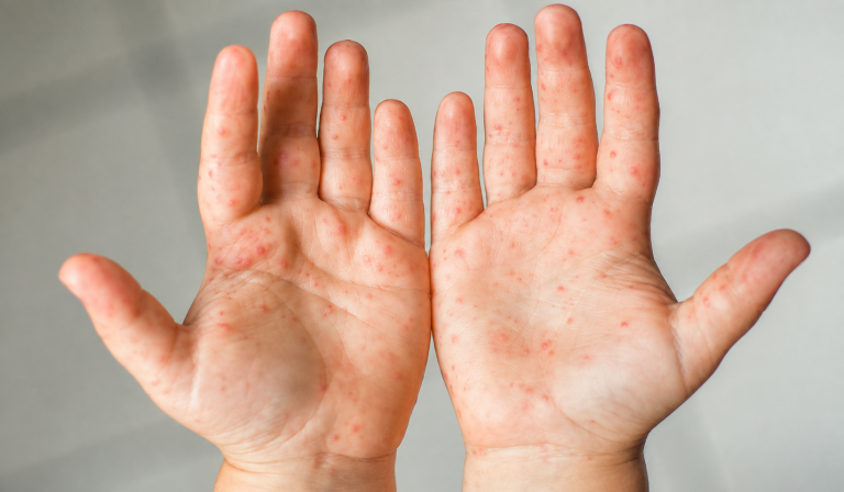 Enfermedad boca-mano-pie: qué hacer ante un contagio y cuáles son sus señales de alerta