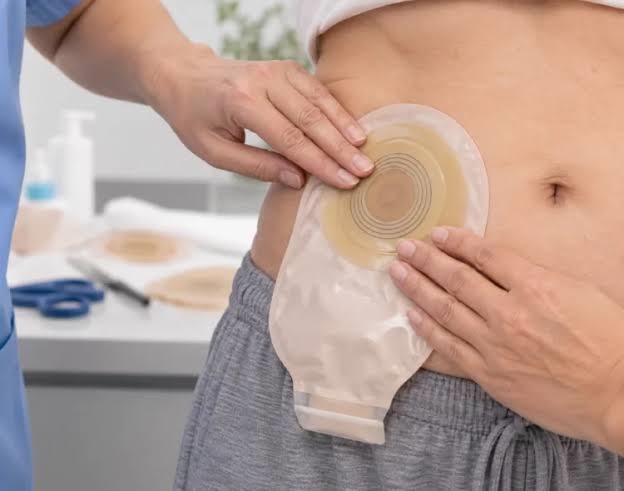 [Podcast] Pacientes ostomizados: una discapacidad que no se ve, pero que la sociedad debe atender